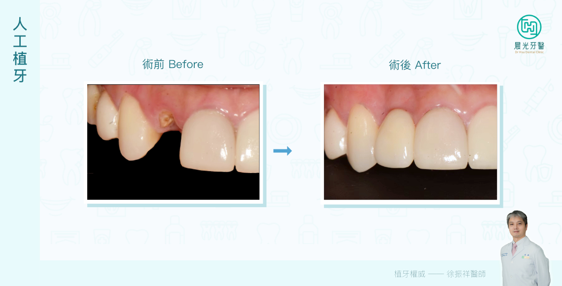 分不清真假，宛如⾃然牙