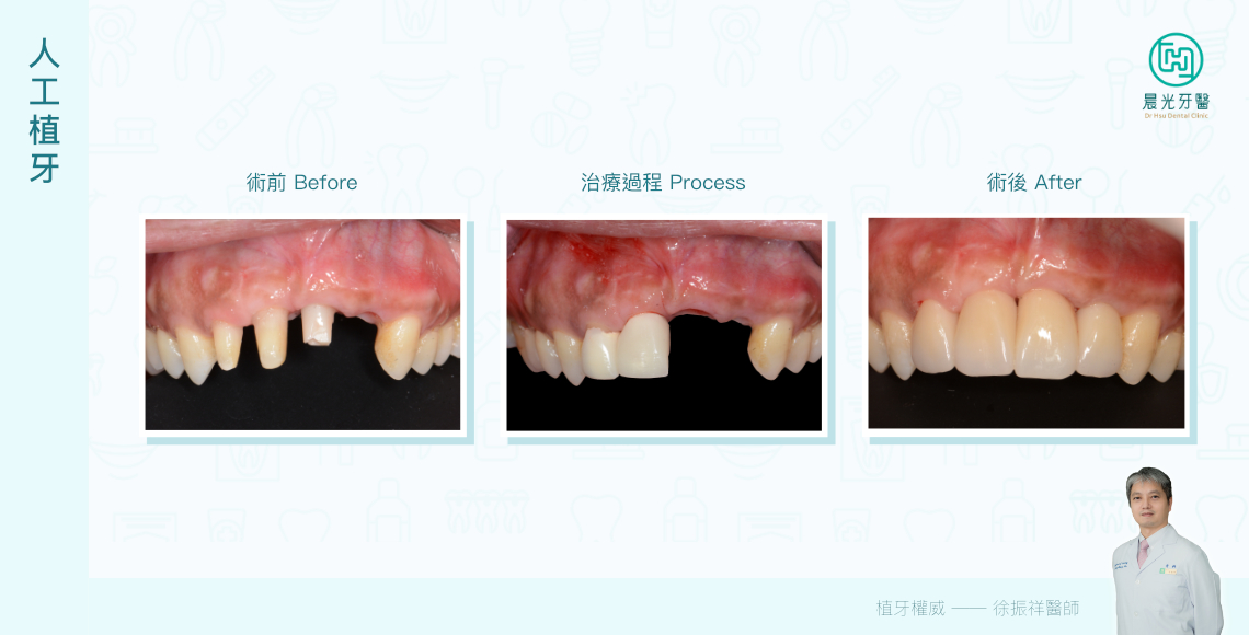 前牙植牙的精湛藝術
