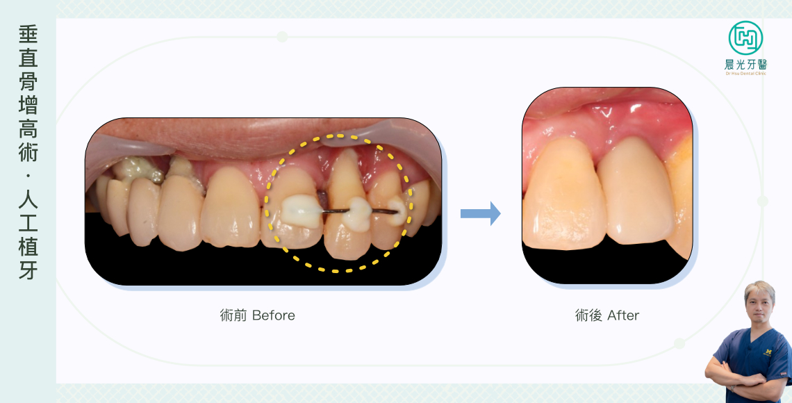牙齒搖搖欲墜！