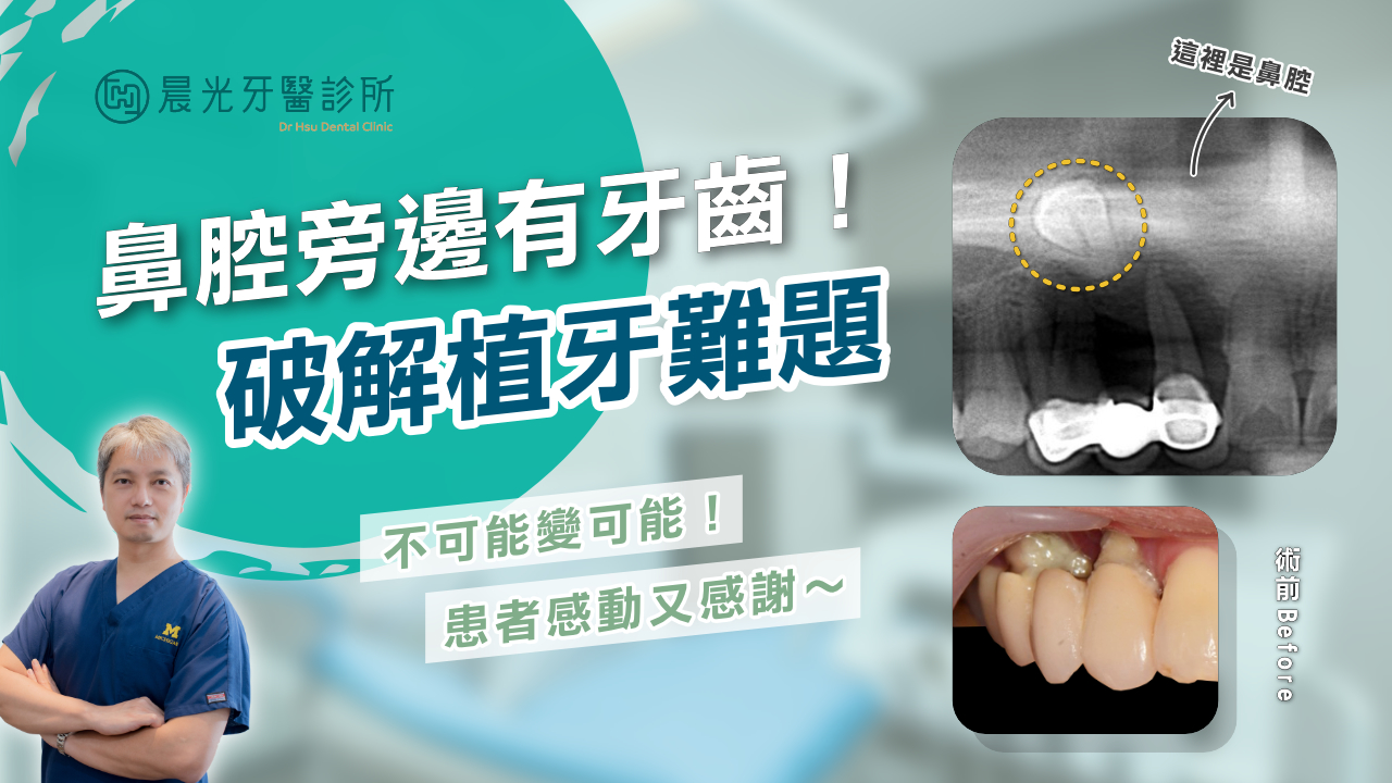 別人都說「一定要手術拔掉」？