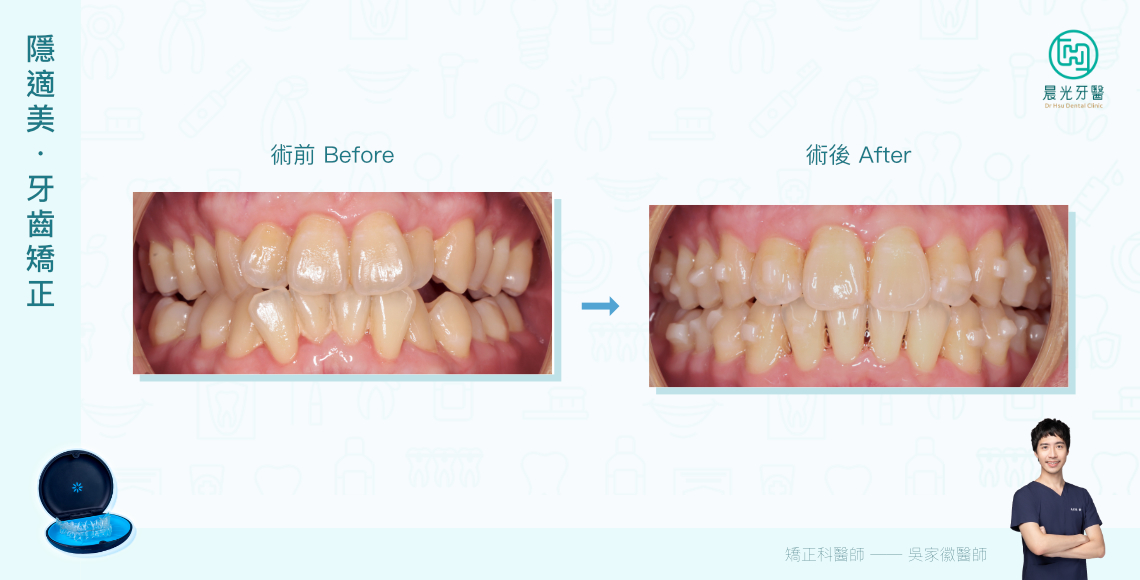 6個月牙齒井然有序