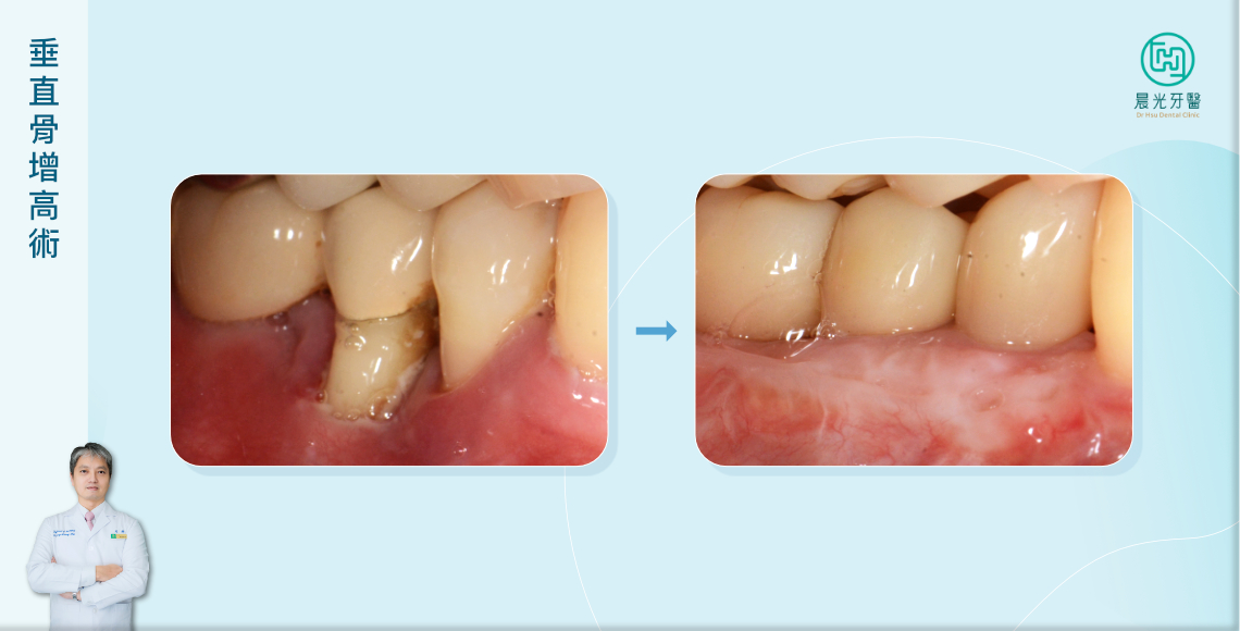 突破骨量限制，重建完美笑容